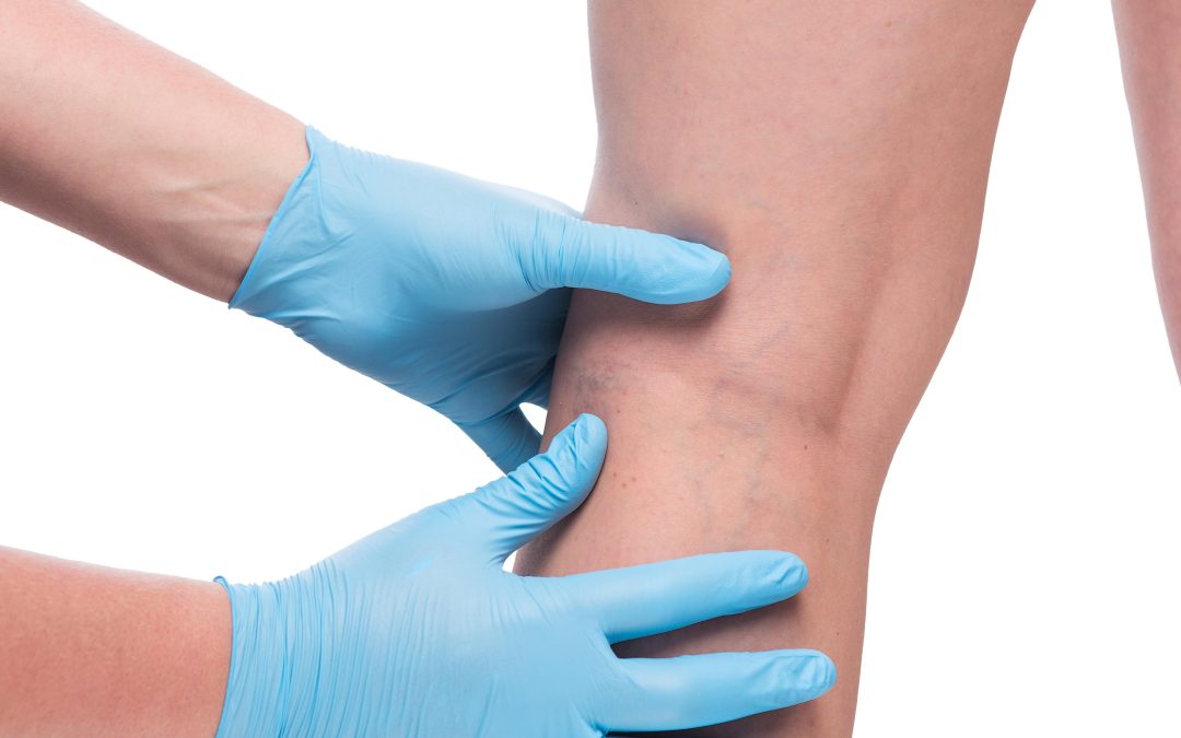 Say Goodbye to Leg Pain with Varicose Veins Treatment in Baltimore, MD, That Works