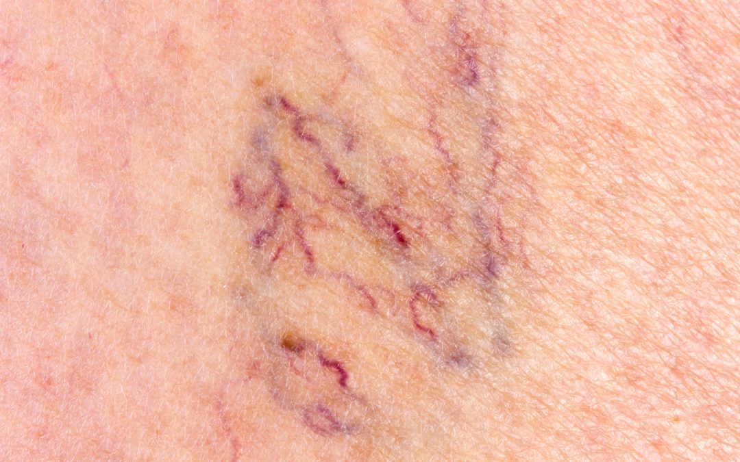 Restore Comfort with Effective Varicose Veins Treatment in Baltimore, MD