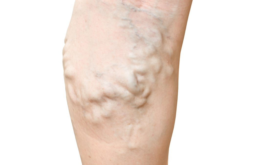 Understanding the Risks and Treatment Options for Deep Vein Thrombosis in Petersburg, VA